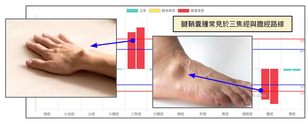 三焦經與膽經容易出現腱鞘囊腫