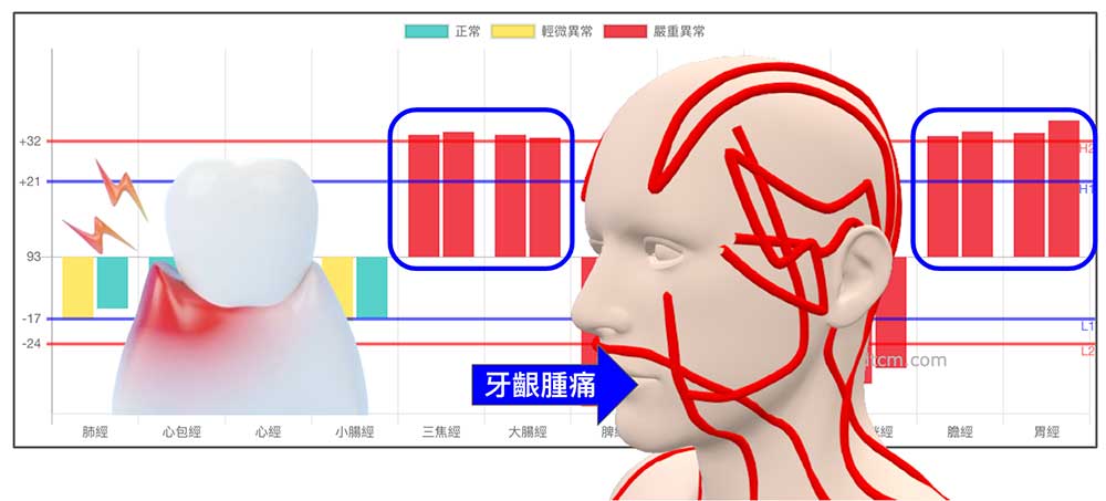 陽明經與少陽經實證時，容易出現牙齦腫痛