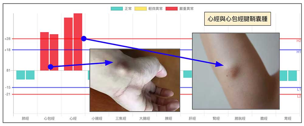 心經與心包經路線上出現腱鞘囊腫