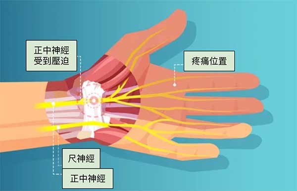正中神經受到壓迫影響食指、中指大拇指