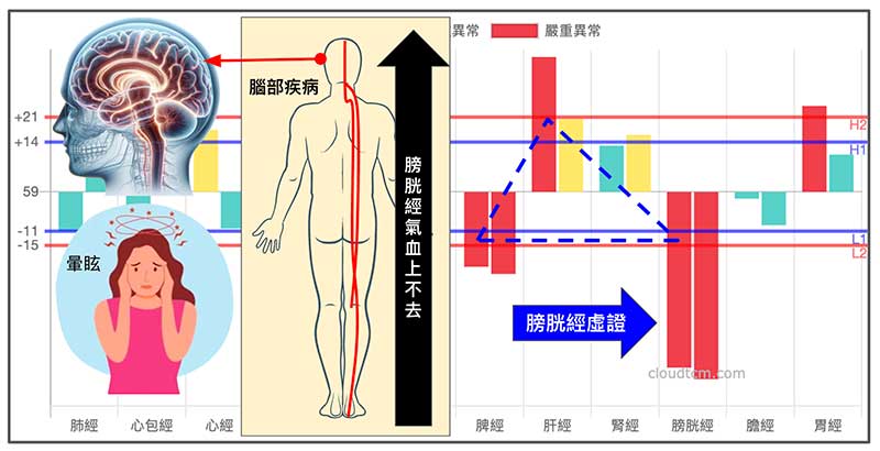 腦中風常見的鐵三角經絡型態