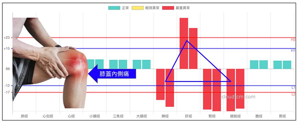 鐵三角經絡型態，最容易出現膝蓋內側痛