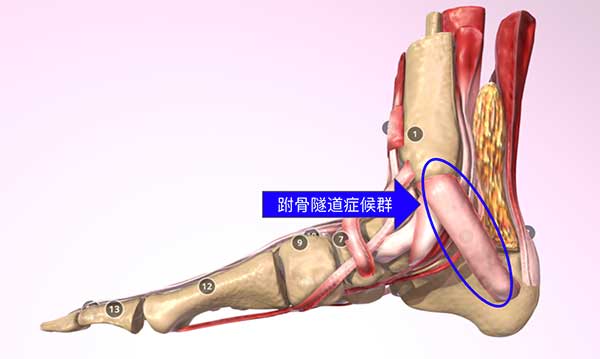 跗骨隧道症候群，經常出現腳踝內側痛