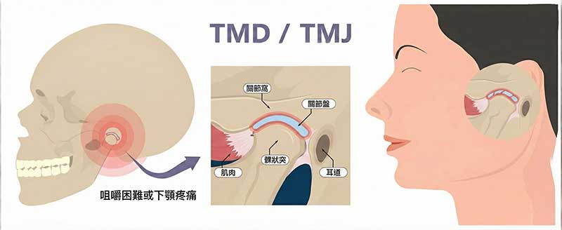 顳顎關節與肌肉障礙是一個相當令人困擾的疾病