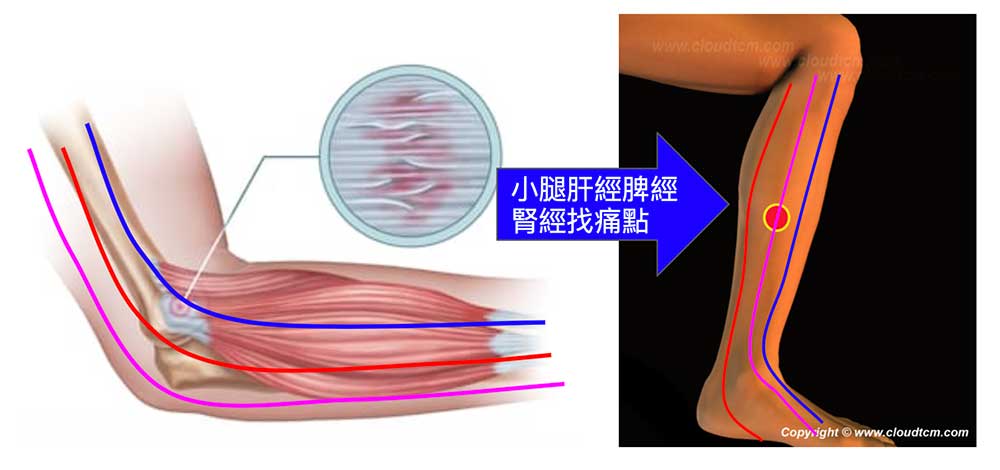 改善網球肘可以在腳上的肝經、脾經與腎經上找痛點按摩