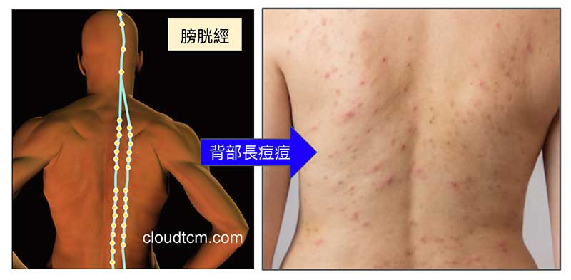 全身氣血瘀阻，痘痘會反應在膀胱經上
