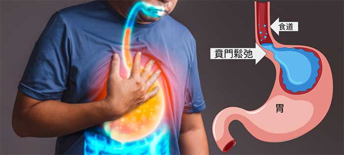 胃賁門鬆弛關不住,胃酸往上跑形成食道逆流