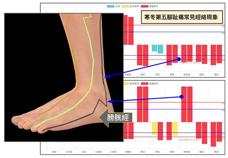 冬季出現第五腳趾痛的機率較高