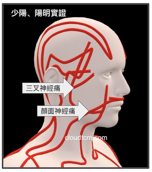 當少陽經、陽明經實證時，出現顏面神經痛