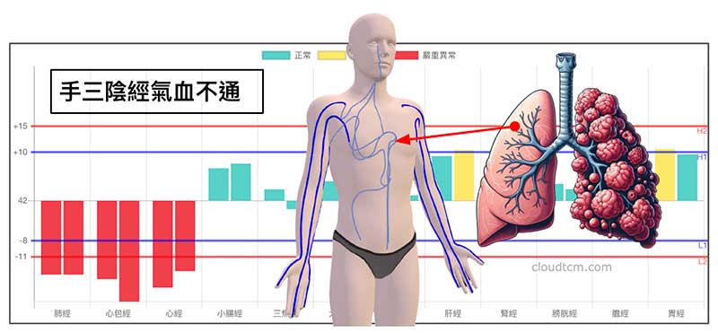 手三陰經阻塞，可能與肺癌有關聯