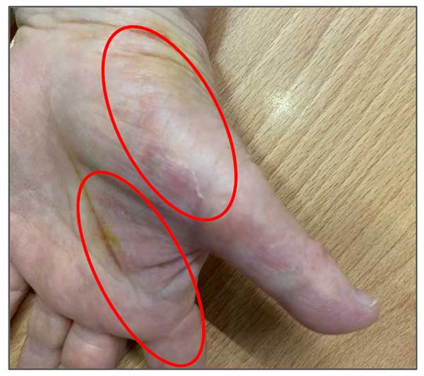 某人出現汗皰疹的位置，就是在肺經與大腸經上