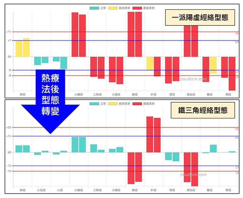 有一定比例的人，在熱療之後出現鐵三角經絡型態