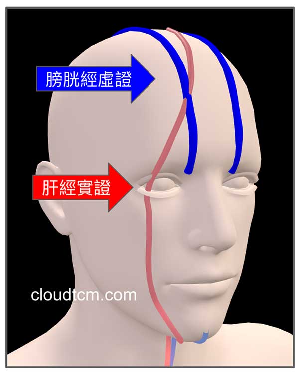夏季的特殊經絡現象，很容易出現頭痛