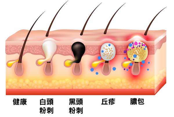 一年四季都有可能出現粉刺面皰