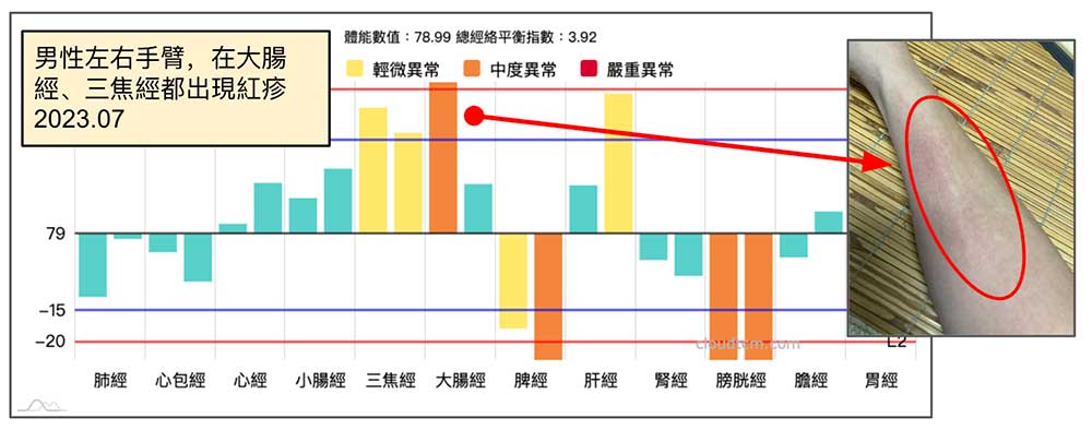 2023年夏季手臂紅疹出現在大腸經、三焦經上